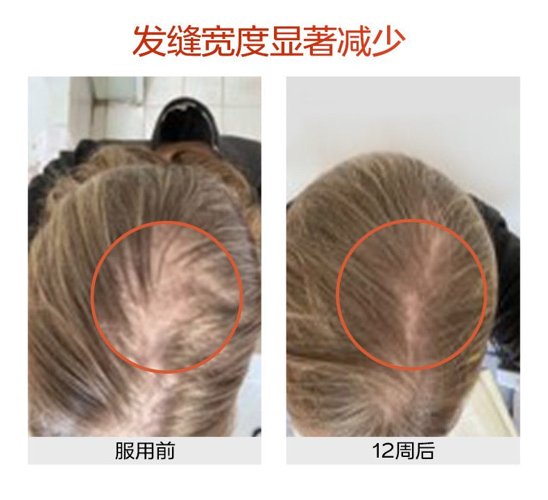 【P728】💥新会员限时专享💥✨胶原配合生发套组 ✨VG 胶原蛋白精准肽 + 蘊发胶囊 配套组 ❤️