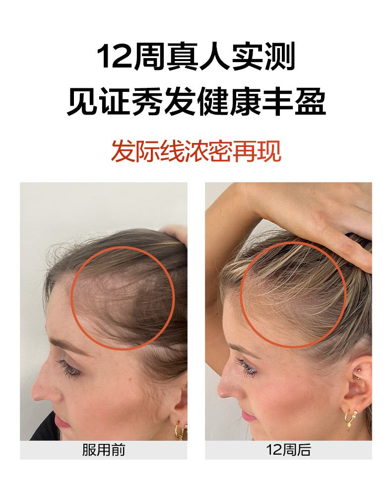 【P728】💥新会员限时专享💥✨胶原配合生发套组 ✨VG 胶原蛋白精准肽 + 蘊发胶囊 配套组 ❤️